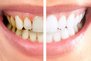 pulizia dentale: via i denti gialli