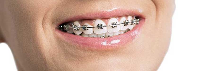 Apparecchio per i denti: può causare danni collaterali?
