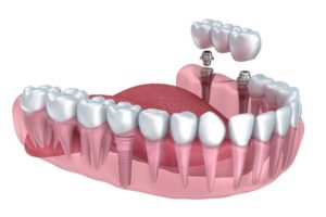 dentiera o implantologia