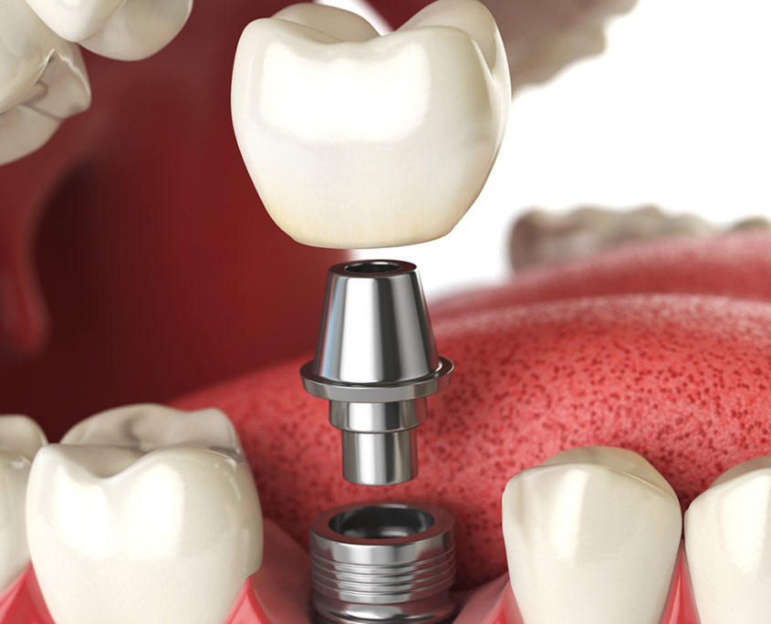 dental-implant-rejection-because-it-is-a-false-belief