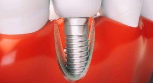 dental implant infection
