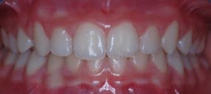 deep bite milan orthodontics